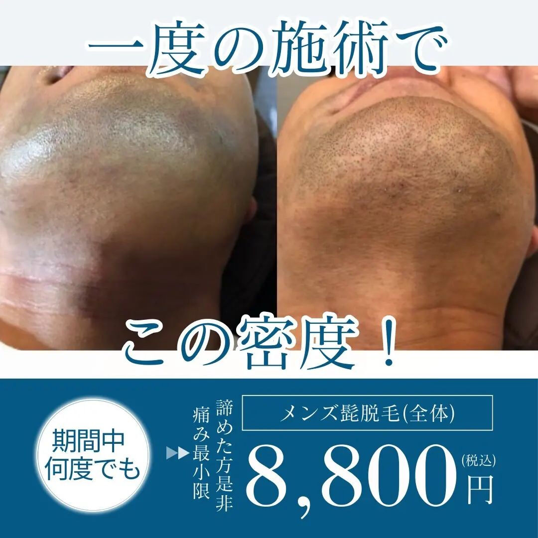 群馬県高崎市✨医療機関でも注目の最新マシンを使用した脱毛サー